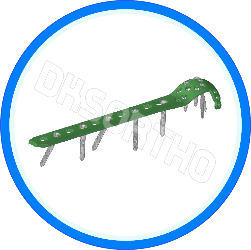 2.4 mm / 2.7 mm Advance Anterolateral Distal Tibia Locked Plate (Variable Angle)